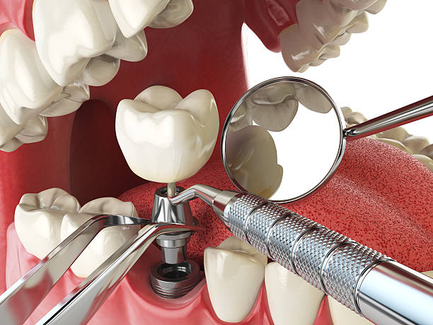 Best Emergency Treatment for Dental Infections or Abscesses in Wolcott, IN